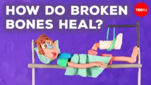How Broken Bones Heal: A Step-by-Step Guide
