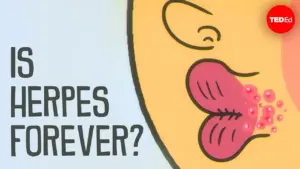 Understand Herpes: Causes, Symptoms, and Treatment Options